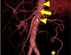 7. Computed tomography showing stenosis of the superior mesenteric artery (SMA) and occlusion of the celiac and inferior mesenteric arteries