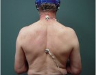 15. Subject with markers attached to head, and over C7, T8 and sacrum, for spine motion analysis during walking
