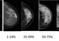 Mammography and breast density