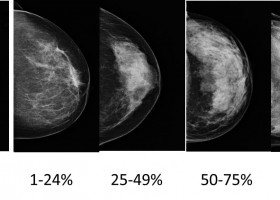 Mammography and breast density