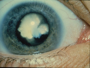 Cataract (National Eye Institute CC)