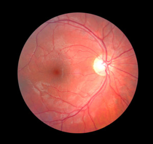 Retinal Photograph inside the eye.