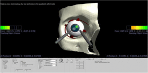 Cataract Surgery Training Simulator, published in the BMC Ophtalmology article above. See the full paper for more images.