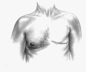 man-breast-cancer
