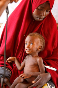 Mother holding malnourished child