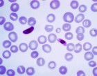 Thin blood smear of Plasmodium falciparum macro- and microgametocyte