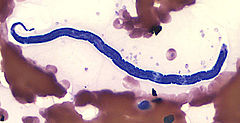 Loa loa microfilaria in a thin blood film: Images from Wikimedia commons