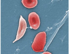 1911_Sickle_Cells credit openstax college