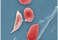 1911_Sickle_Cells credit openstax college