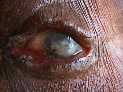 onchocerca volvulus eye