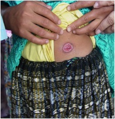Ulcerative skin lesion on patient who has cutaneous leishmaniasis. (Credit: B. Arana, MERTU, Guatemala, via CDC)
