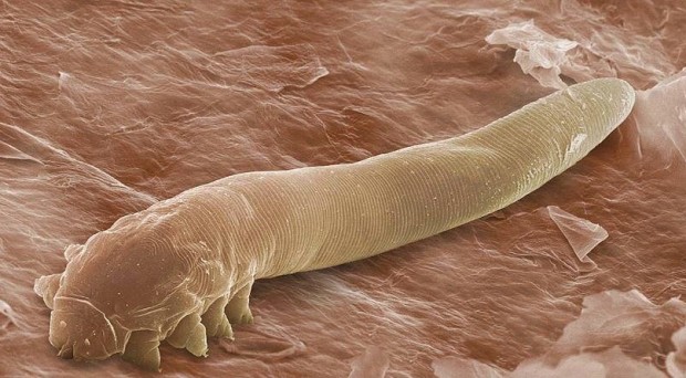 BugBitten Mites in your follicles