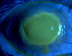 Eye with Acanthamoeba keratitis (fluorescein observation). Imaged from Wikipedia