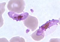 Gametocytes of P. falciparum in a thin blood smear