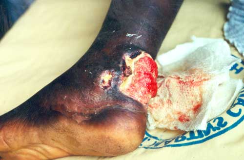 Buruli Ulcer can be caused by infection with M. ulcerans bacteria. Arsenic in water increases the risk of Buruli ulcer development