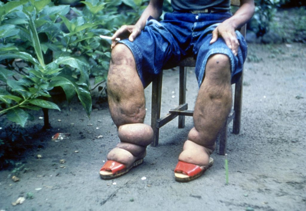 Elephantiasis due to lymphatic filariasis infections. WASH is critical for morbidity management