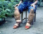 Elephantiasis due to lymphatic filariasis infections. Source: Wikimedia Commons