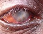 Blindness caused by repeated infection with Chlamydia trachomatis