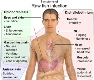 BugBitten Does your sushi contain parasites?