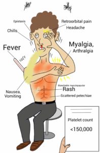 Symptoms of a dengue infection. Source: Wikicommons