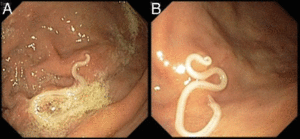 Anisakis firmly attached with its end penetrating the gastric mucosa. From https://casereports.bmj.com/content/2017/bcr-2016-218857.full