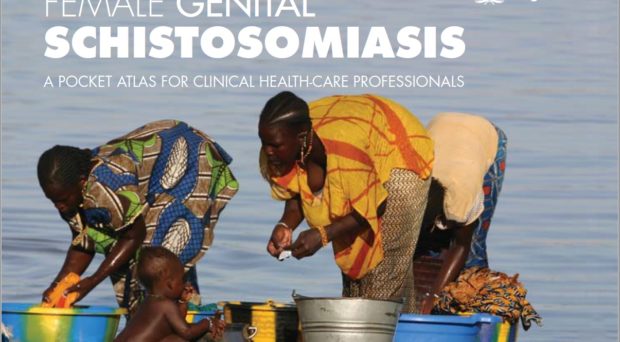A case schistosomiasis - Schistosomiasis define