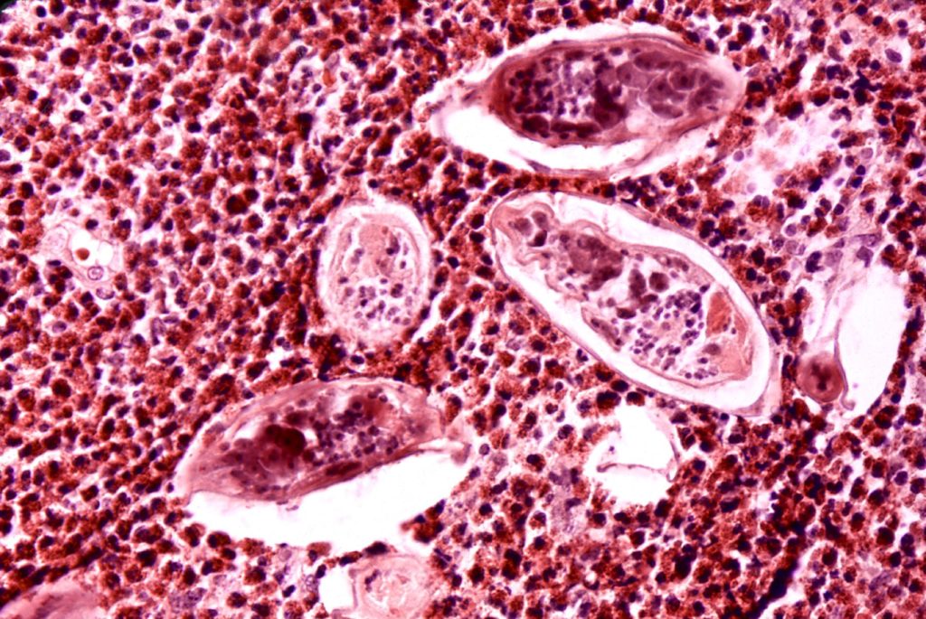 urogenitális schistosomiasis