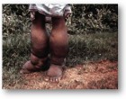 Elephantiasis. Source: Sara Holmes Liverpool School of Hygiene and Tropical Medicine