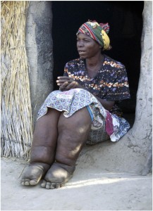 Lymphatic Filariasis patient-a picture of despair and anxiety. 