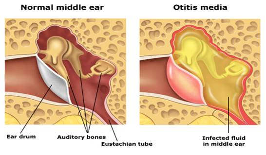 Inflammation of ear drum and infected middle ear fluid in Otitis Media compared with normal ear.