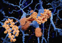 Alzheimer’s disease: the amyloid-beta peptide accumulates to amyloid fibrils that build up dense amyloid plaques.