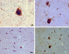 Lewy_bodies_(alpha_synuclein_inclusions)
