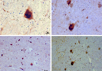 Lewy_bodies_(alpha_synuclein_inclusions)