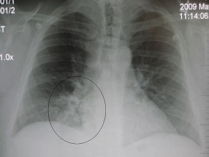 Chest x-ray, showing pneumonia in right lower lobe. Image credit: James Heilman, MD/Wikimedia Commons
