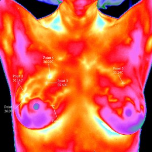 Thermography of breast cancer. Image credit: Danvasilis/Wikimedia Commons
