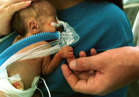 800px-Premature_infant_CPAP