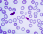 Blood smear containing P. falciparum parasite