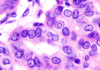 Histopathological image of thyroid cancer