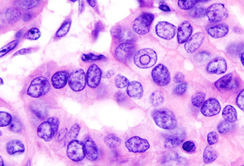Histopathological image of thyroid cancer
