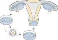 In-vitro_fertilization_(IVF)