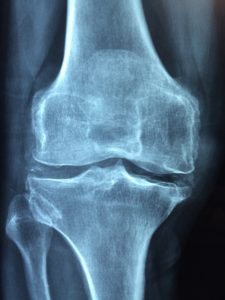 Many people with arthritis have to have knee replacement surgery