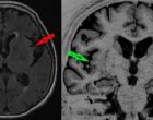 Brain MRI of a dementia with Lewy bodies patient at the prodromal stage with clear atrophy of the insula (red and green arrows)