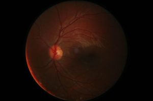 Early detection of diabetic retinopathy is vital to prevent loss of vision.