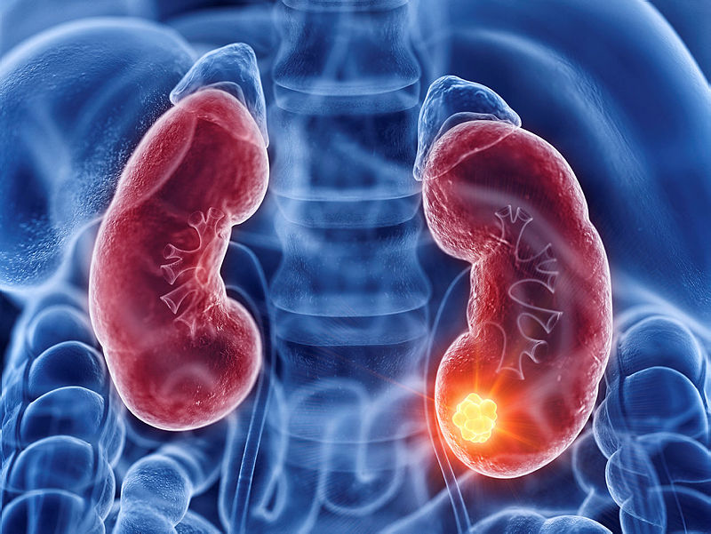 Screening for kidney cancer in Leeds On Medicine