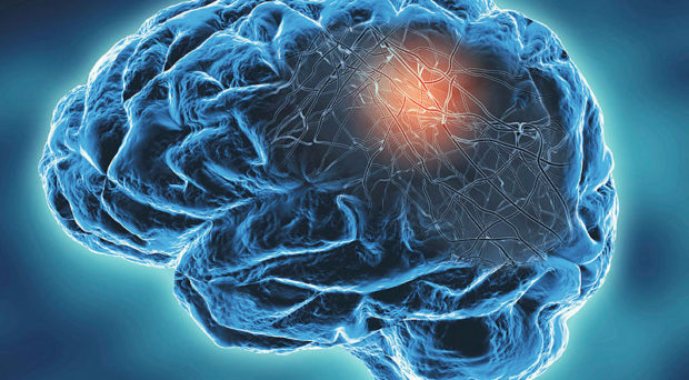 Neurodegenerative disease concept illustration with neural networks