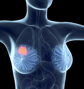 Illustration of breast cancer