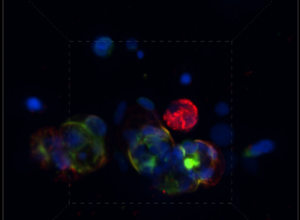 Integrated triple-stained imaging (DAPI, Vimentin and Pan-CK), showing how different dyes can be visualized at the same time to help better understand tumor response to treatment 